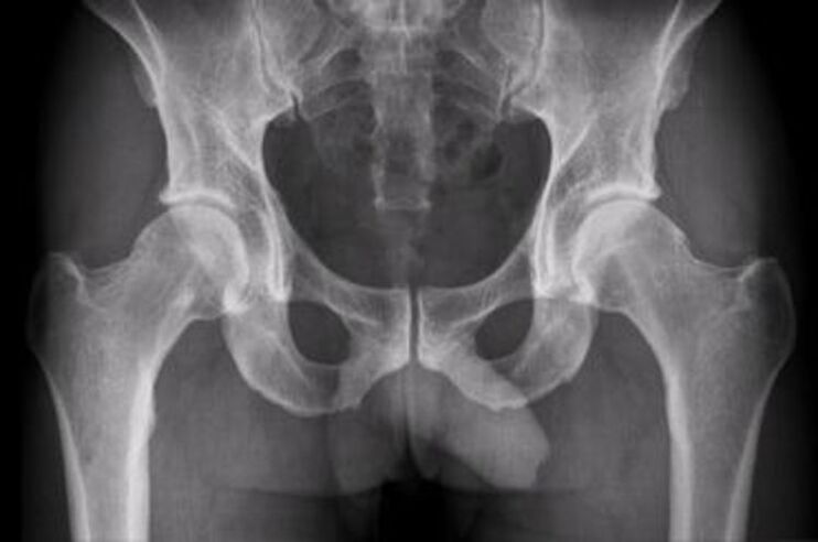 radiografía da articulación da cadeira para a dor