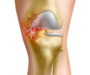 Inflamación das articulacións