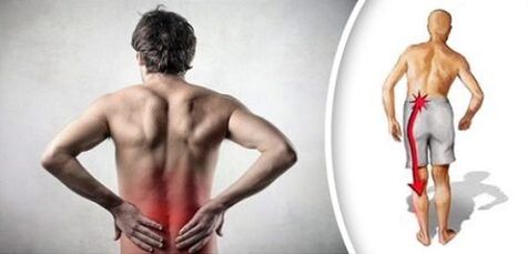 A síndrome da dor coa osteocondrose lumbar exalta nas pernas