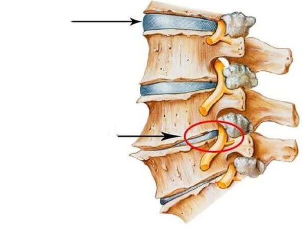 disco intervertebral normal e danado na columna vertebral