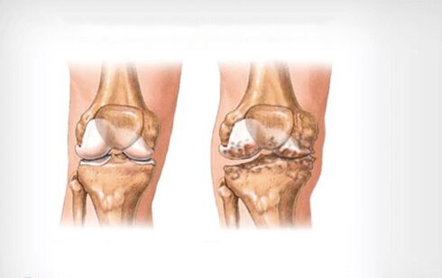Osteoartrite da articulación do xeonllo